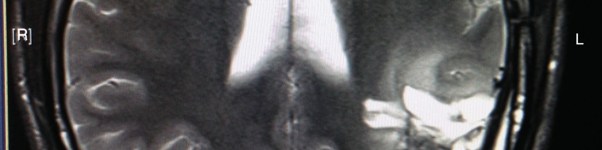 MRI scan July 2014 2