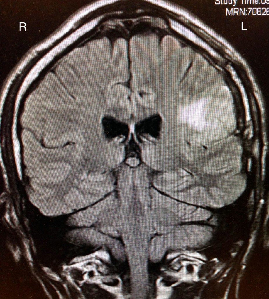 MRI brain scan 30 Oct 14